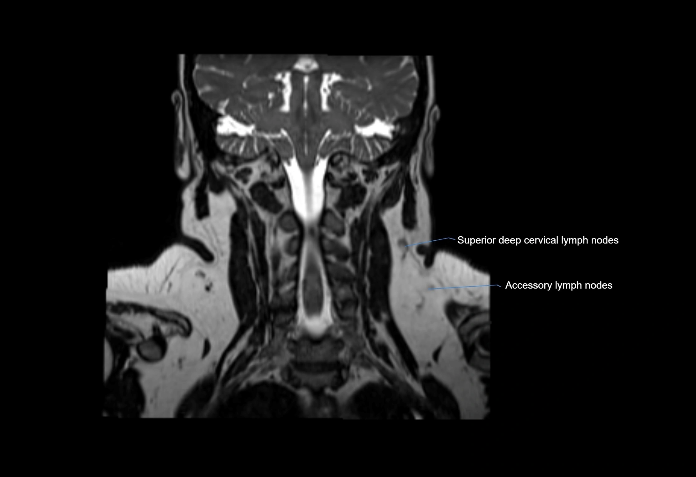 Neck coronal lymph node cross sectional MRI anatomy 3T MRI  image-img-00001-00022.webp